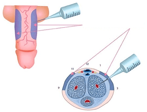 Inyecciones para engrosar el pene
